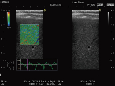 }2@ Real-time Tissue Elastography