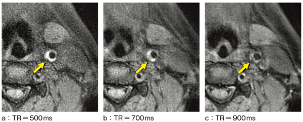 図1 T1強調SE像におけるTRの違いによるプラークイメージングの比較