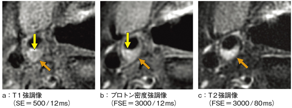 図2 標準化案に則って撮像したMRプラーク画像