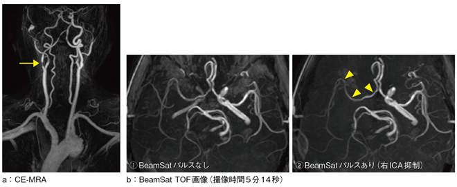 図5 CE-MRA画像とBeamSat TOF画像(右頸部内頸動脈狭窄)