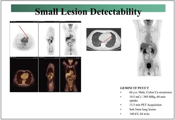 }8@GEMINI TF̉摜iImages Courtesy of University Hospitals, Clevelandj