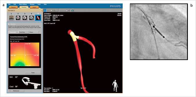 }1@3D-CAiajStentBoostibj