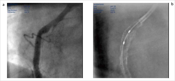 }2@StentBoost Subtract