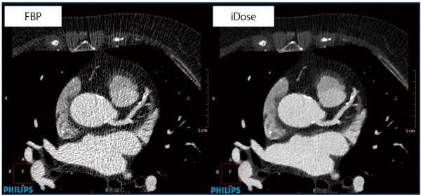 図3 iDose4の臨床画像
