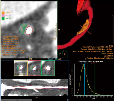 図5 Plaque Analysis