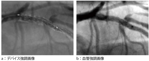 }2@StentBoost Subtract ǑeǉBeCI[o[C邱ƂŁCXegƌǂΔ䂵Ȃώ@łB