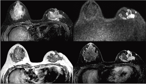 }2@SmartExam Breastɂ肵BMRIBi摜񋟁FdFNjbNlj