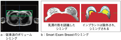 図2 Smart Exam Breastの静磁場シミング