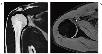 図6 Torso Coilによる肩関節の撮像例