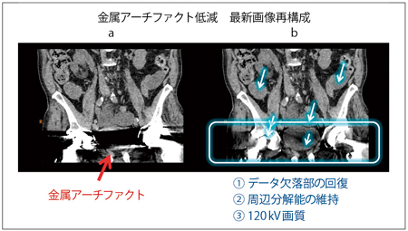 図4 O-MARの特長 a:従来再構成 b:O-MAR