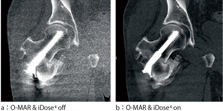 図7 O-MAR & iDose4併用画像例