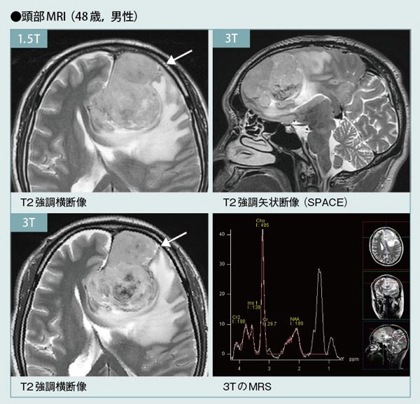 頭部MRI
