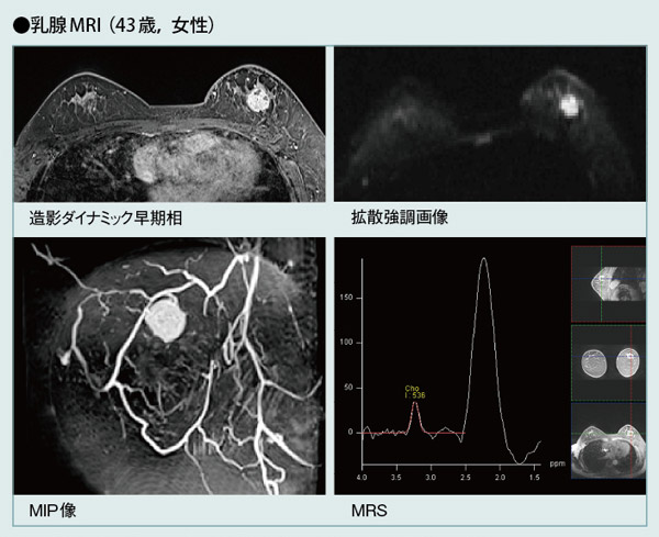 乳腺MRI