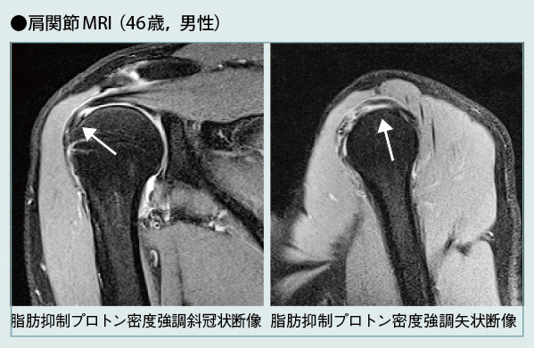 肩関節MRI