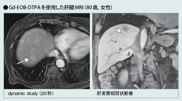 Gd-EOB-DTPAを使用した肝臓MRI
