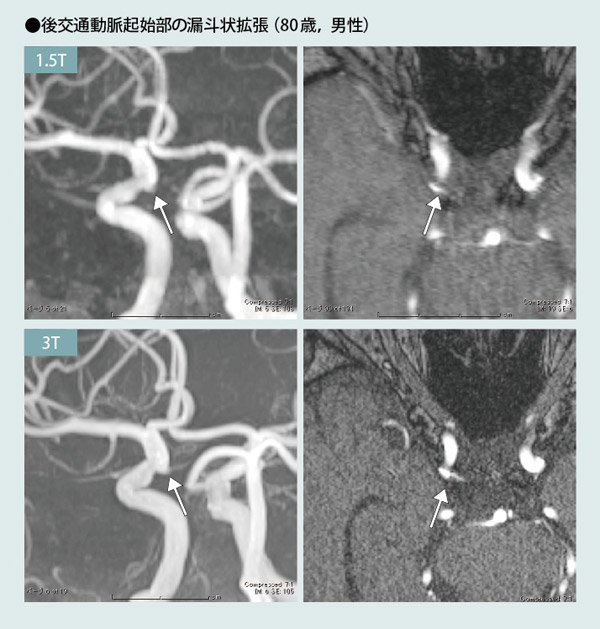 後交通動脈起始部の漏斗状拡張