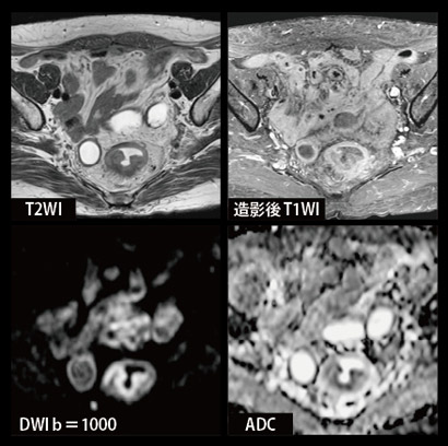 図2 直腸がん症例(69歳,女性)