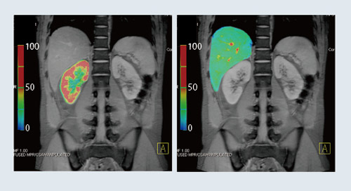 図2 2D PACE併用 T2*Mapping