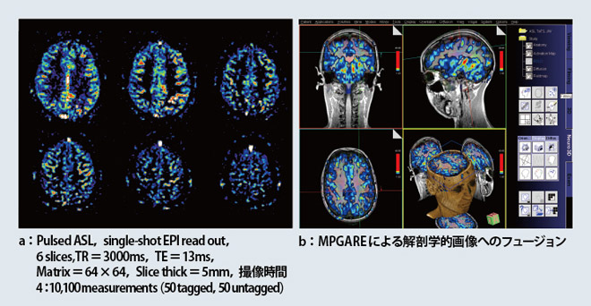 図4 自動位置ズレ補正機能によるsyngo ASL