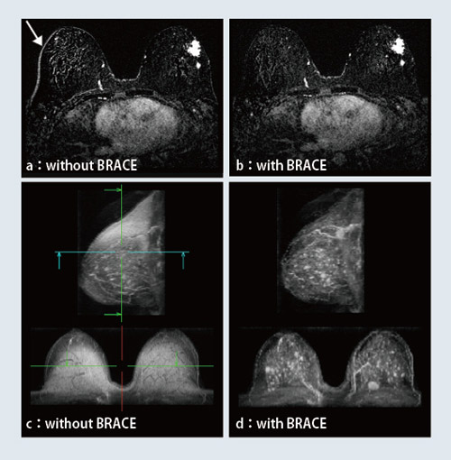 図5 syngo BRACEによる乳房画像の位置ズレ補正
