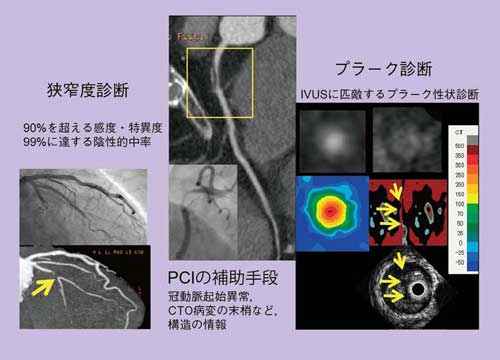 図1　DSCTによる左冠動脈画像