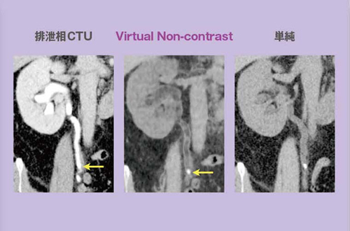 }5@Virtual Non-contrast摜