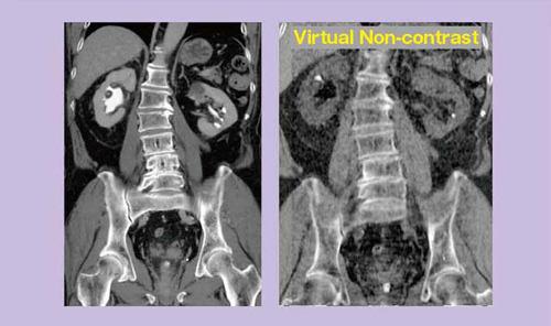}6@ǌ󐫓IAǗVirtual Non-contrast摜iEj