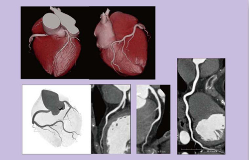 図3 68歳,男性,胸痛精査