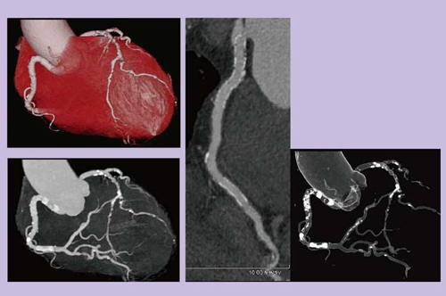 図4 74歳,男性,ステント留置フォローアップ