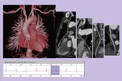 図5 78歳,男性,CABGフォローアップ