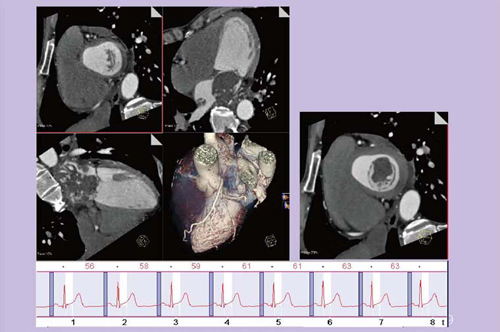 図6 47歳,男性,心臓腫瘍