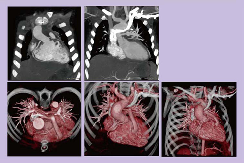 図8 4歳,男児,心室中隔欠損・肺動脈閉鎖症術後