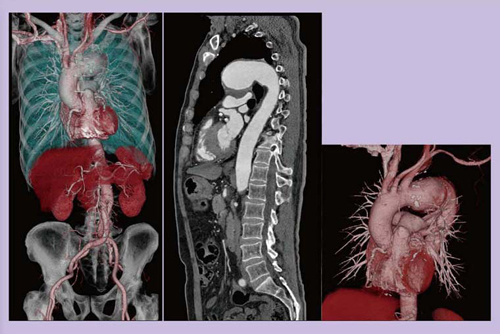 図9 65歳,女性,TAA術前