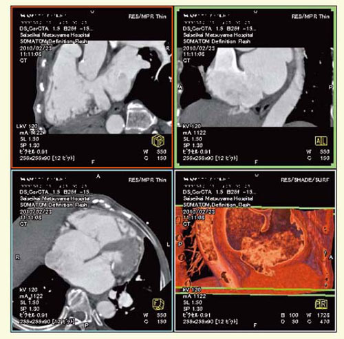図4 症例1:心房中隔欠損の術前評価