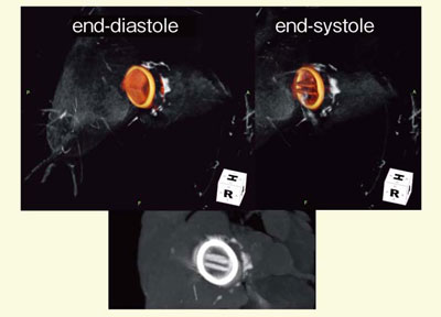 図5 症例2:弁置換術後の評価