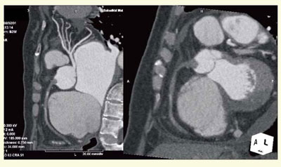 図6 症例3:高心拍・心房細動の急性心筋梗塞例
