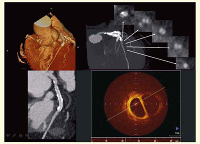図7 症例4:CTOのPCI後の血管内腔評価