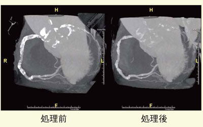 図8 症例5:IRISによるノイズ低減と石灰化除去の試み