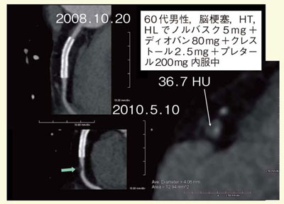 図9 症例6:冠動脈治療効果判定