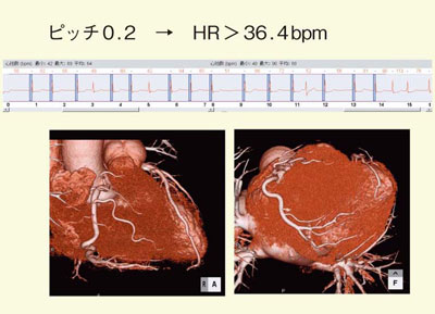 図6　Af症例（RR間隔が時々短い）の心電図edit画像