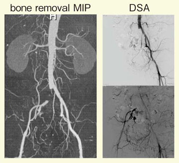 }2@bone removal CTA