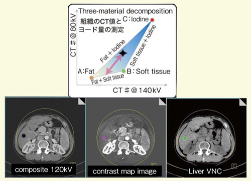 }4@Three-material decompositioňLiverVNCC[h}bv