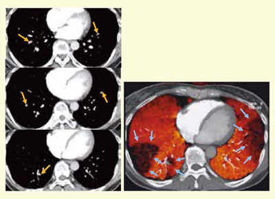 図2　LungPBVを用いた急性肺血栓塞栓症の診断