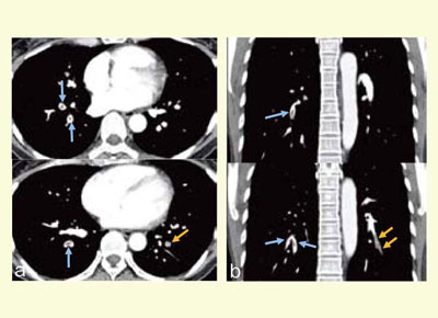 図3　両下葉の肺血栓塞栓症のCTPAとLungPBV　CTPA（左）で両下葉に血栓が認められるが，LungPBV（右）では右下葉には欠損が描出されていない。