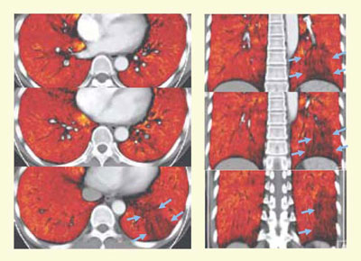 図3　両下葉の肺血栓塞栓症のCTPAとLungPBV　CTPA（左）で両下葉に血栓が認められるが，LungPBV（右）では右下葉には欠損が描出されていない。