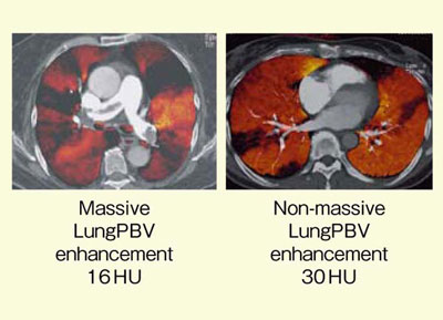 図4 LungPBVと重症度との関係