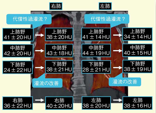図5 血栓溶解療法前後のLungPBVのCT値の変化