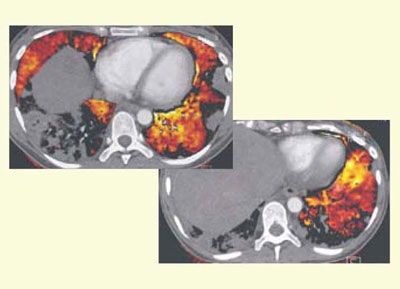 図6　子宮がん，肝転移症例のLungPBV　LungPBVのくさび形の欠損像から腫瘍塞栓と診断された。