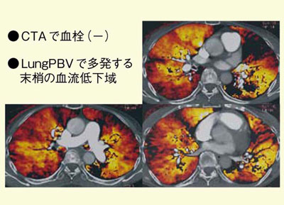 図7　慢性肺血栓塞栓症のLungPBV