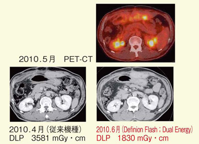図3　結腸がん肝転移の症例（53歳，男性）